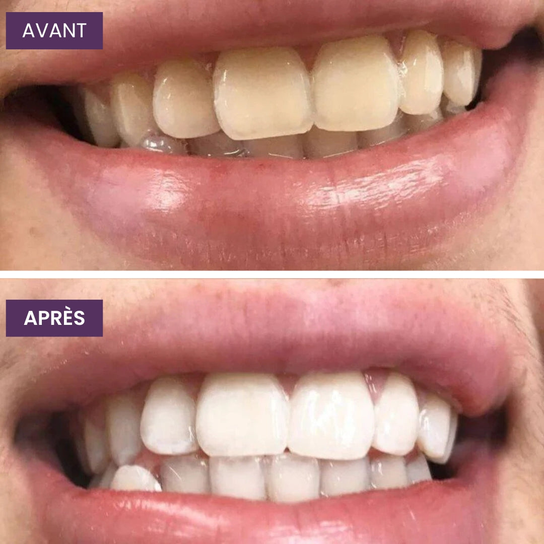 OhMySmile® - Bain De Bouche Blanchissant