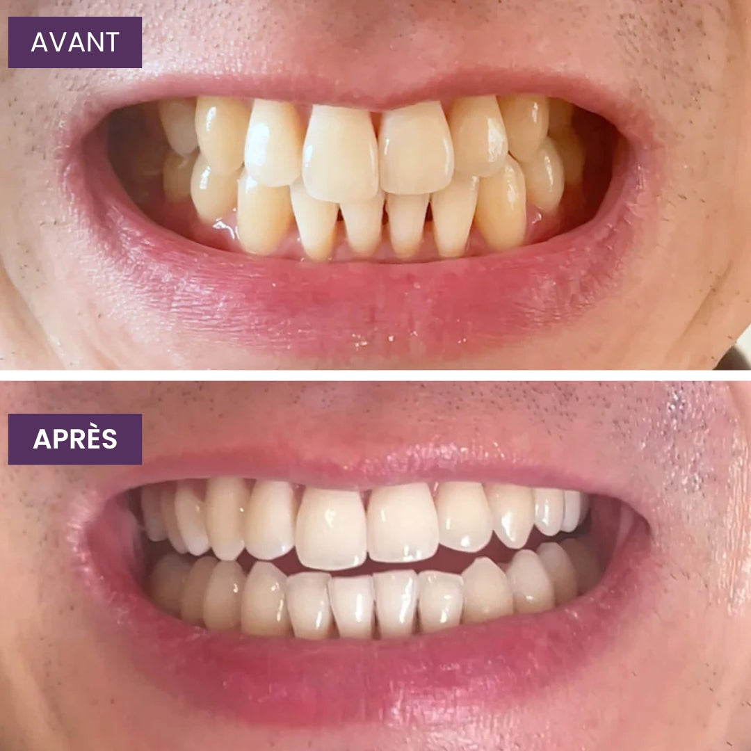 OhMySmile® - Bain De Bouche Blanchissant